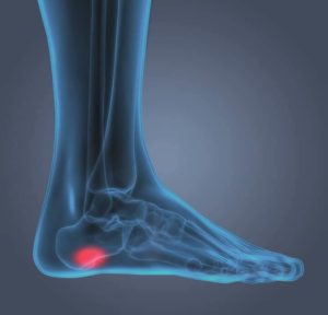 Plantar Fasciitis Symptoms & Pain Relief | Dr. Scholl's